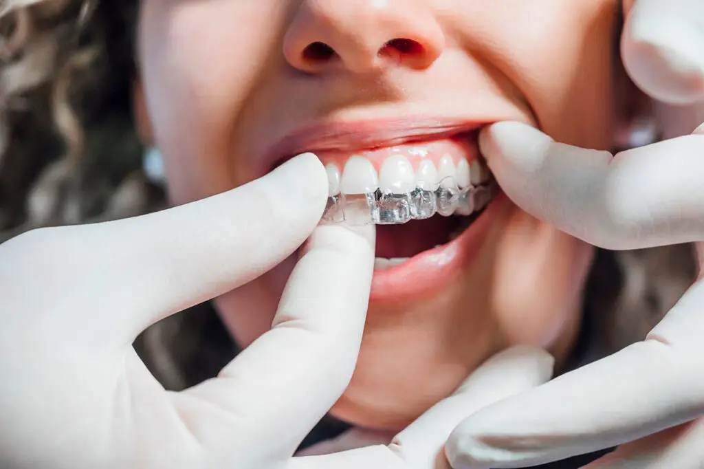 Clear Aligner Therapy In Lansdale: A Convenient Way To Straighten Your Smile