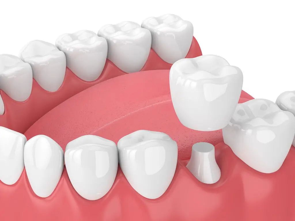 Dental Crowns In Lansdale: How A Crown Can Protect A Weak Or Damaged Tooth