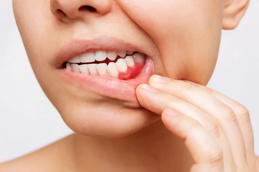 Periodontal Treatment In Lansdale: Protecting The Foundation That Holds Your Teeth In Place