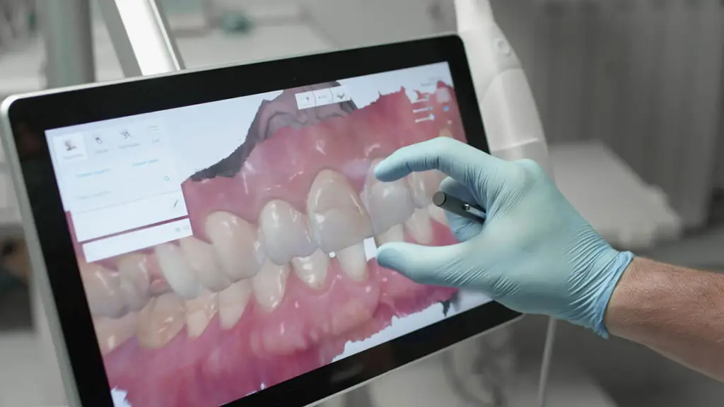 Inlays And Onlays In Lansdale: A Conservative Way To Restore A Damaged Tooth
